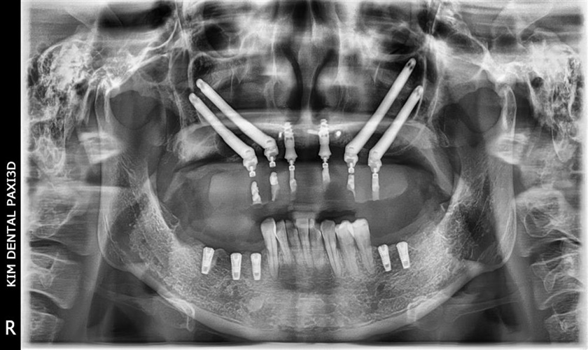Trụ implant sẽ được cắm trực tiếp vào xương hàm như một chân răng thật thụ