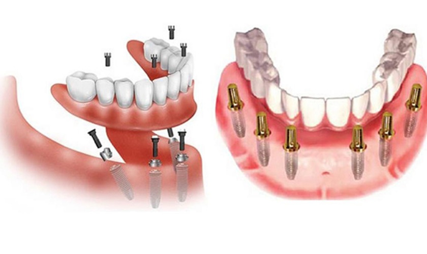 Cần biết quy trình và bảng giá cấy ghép Implant toàn hàm all on 6
