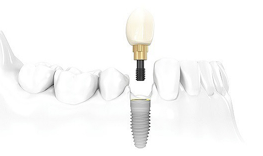 Cần hỏi: Cấy implant giá rẻ có biến chứng nguy hiểm không? Bí quyết cấy implant giá rẻ	