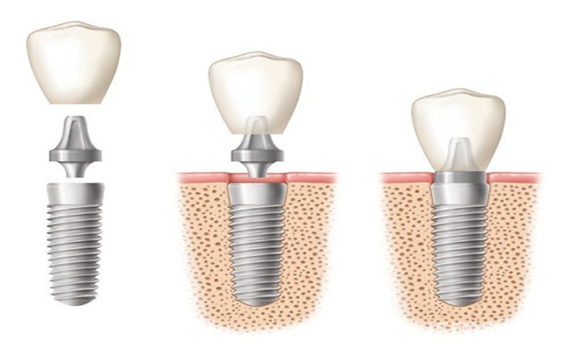 Cần tìm hiểu kỹ về phương pháp trồng răng Implant Nobel trước khi tiến hành trồng răng Implant
