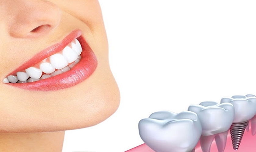 Có nên làm răng implant khi dưới 16 tuổi? Chú ý gì khi làm răng implant?