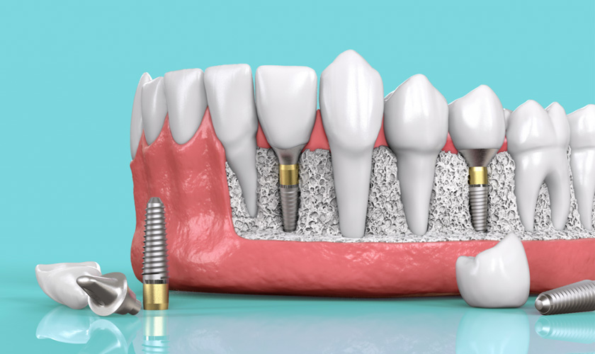 Cấy ghép implant chính là phương pháp phục hình răng phổ biến nhất hiện nay