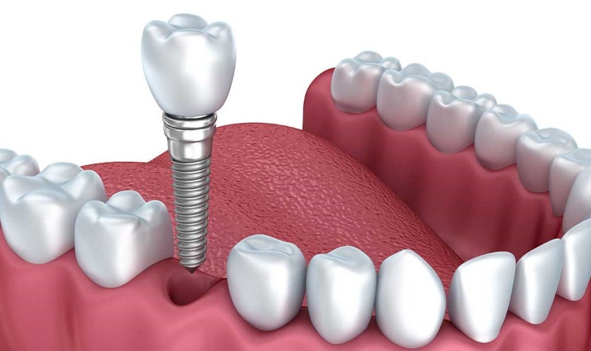 Công nghệ trồng răng implant nào đang được săn đón hiện nay?