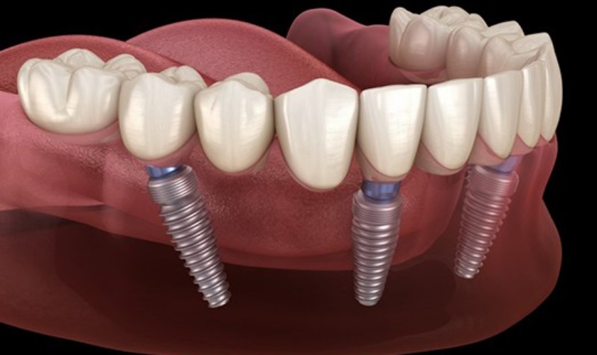 Có rất nhiều công nghệ trồng răng implant nổi trội hiện nay trên thị trường