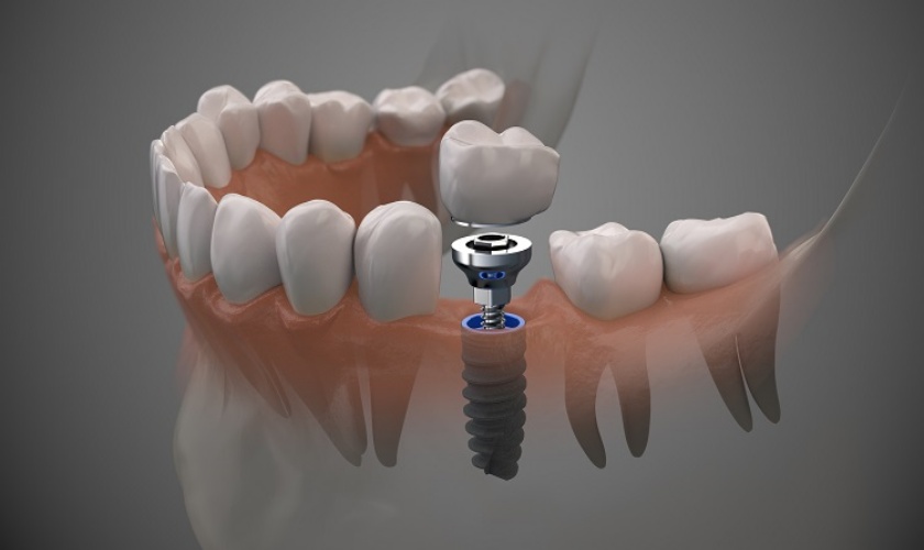 Hỏi: Cấy ghép implant có biến chứng không? Dịch vụ cấy ghép implant chất lượng tại HCM ở đâu?