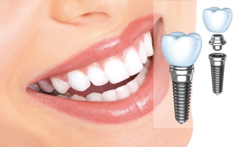 Độ bền của cấy ghép implant được đánh giá cao và tốt hơn cả răng thật