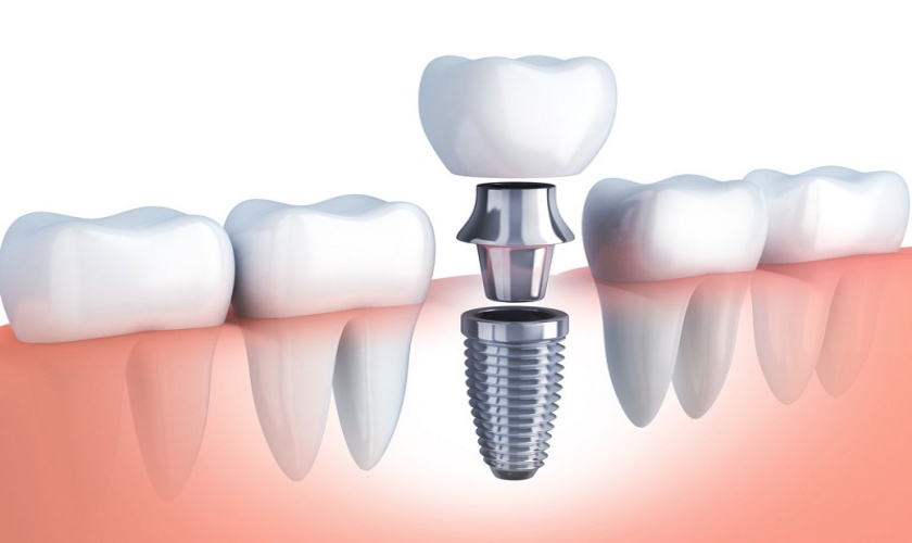Hỏi: Cấy ghép implant có tốt và an toàn không? Địa chỉ cấy ghép implant uy tín ở đâu?