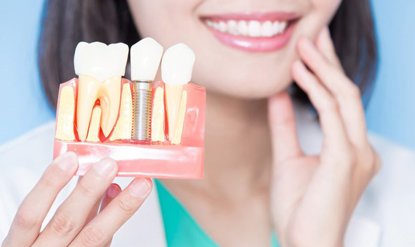 Hỏi – đáp: Trồng răng bằng phương pháp implant Tekka Pháp có tốt như tin đồn?