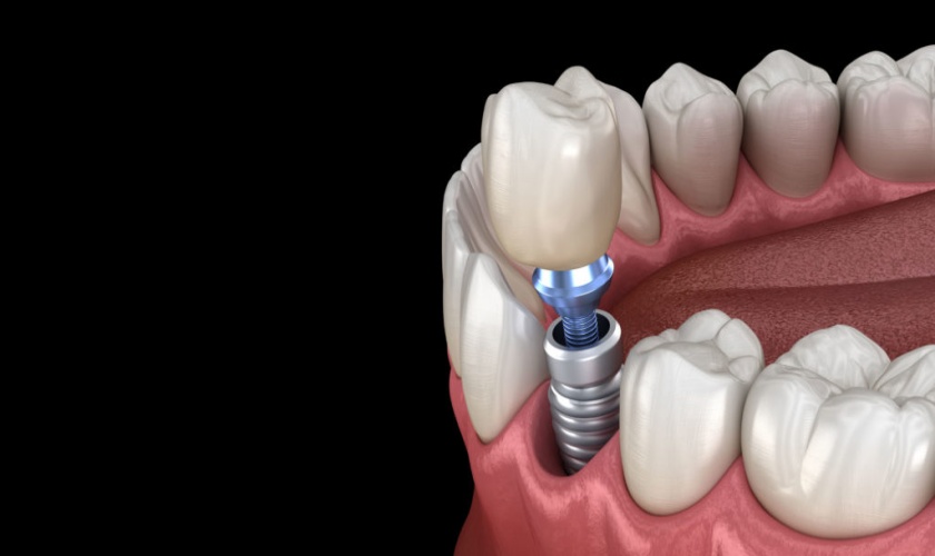 Trồng răng implant Tekka Pháp mang đến hiệu quả cao cho bệnh nhân