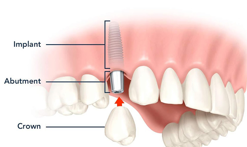 Trụ implant có cấu tạo hoàn toàn giống với chân răng thật