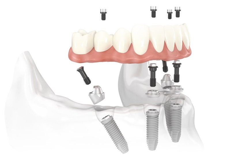 Phương pháp cấy ghép răng Implant All on 4