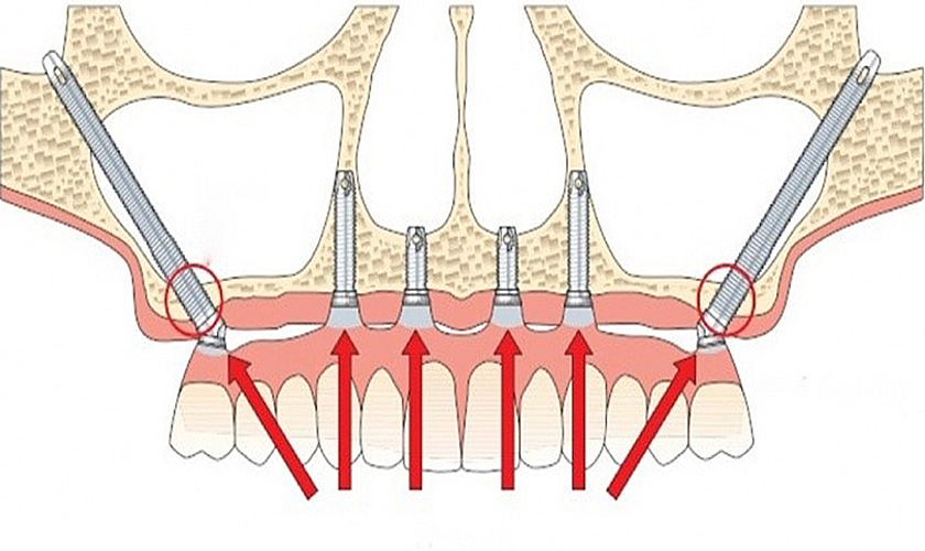 Tư vấn: Nên trồng răng implant xương gò má không? Địa chỉ trồng răng implant ở đâu?