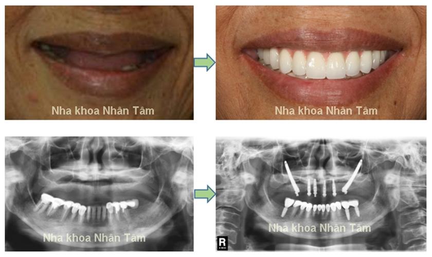 cay-ghep-implant-cho-nguoi-gia