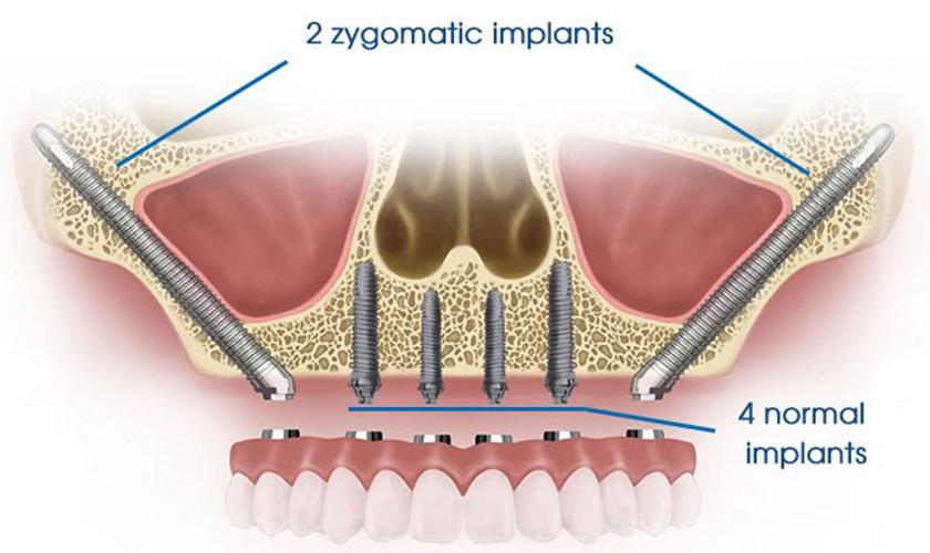 Cấy ghép implant – những lý do không nên trì hoãn
