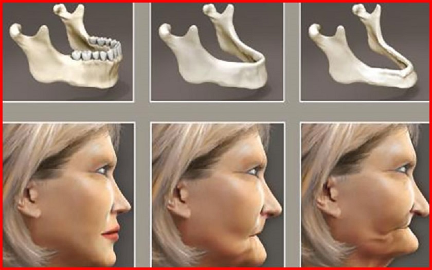 cay-ghep-rang-implant