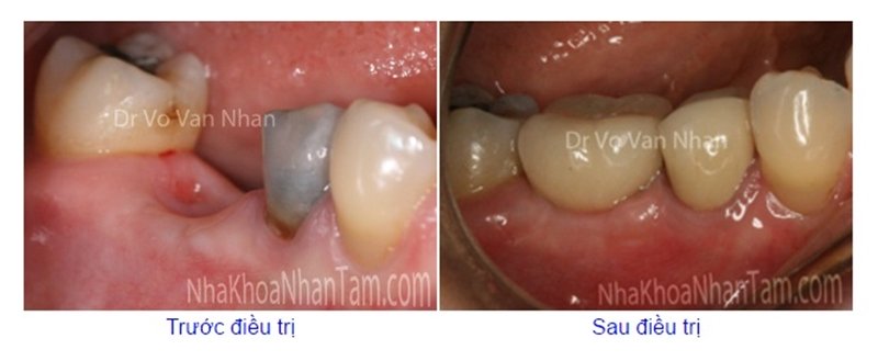cay-ghep-rang-implant-cho-nguoi-gia
