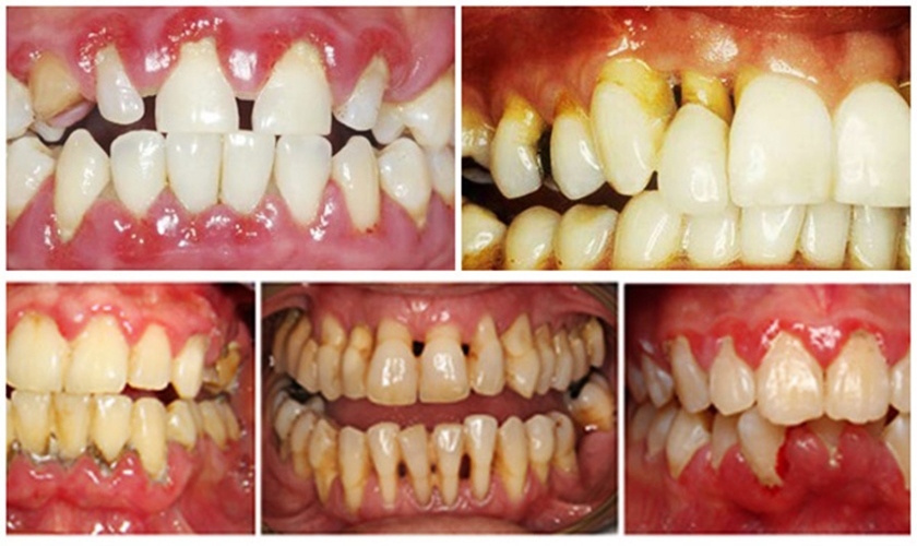 gia-trong-rang-implant