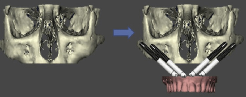 Cấy ghép implant zygomatic là giải pháp phục hình răng hàm trên hiệu quả