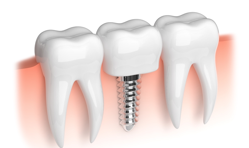 Trồng răng Implant là phương pháp phổ biến trong phục hồi răng mất