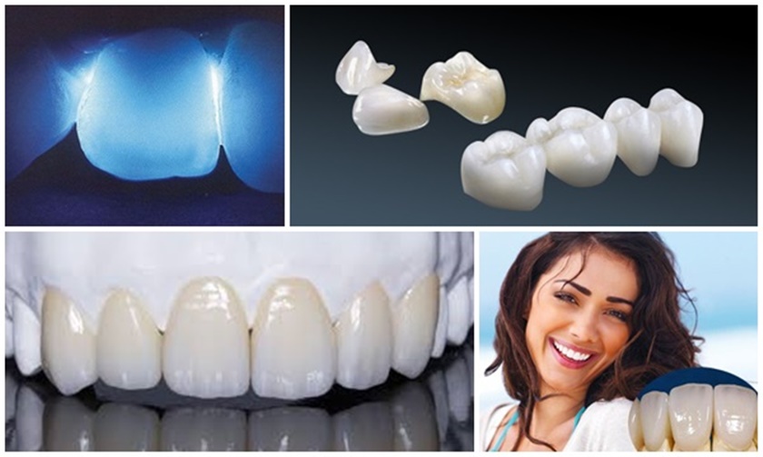 Bọc răng sứ mang lại vẻ đẹp thẩm mỹ cao cho răng
